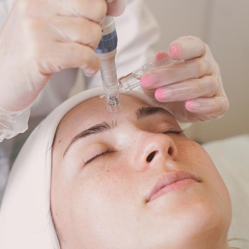 Rostro de mujer recibiendo tratamiento de microneedling facial